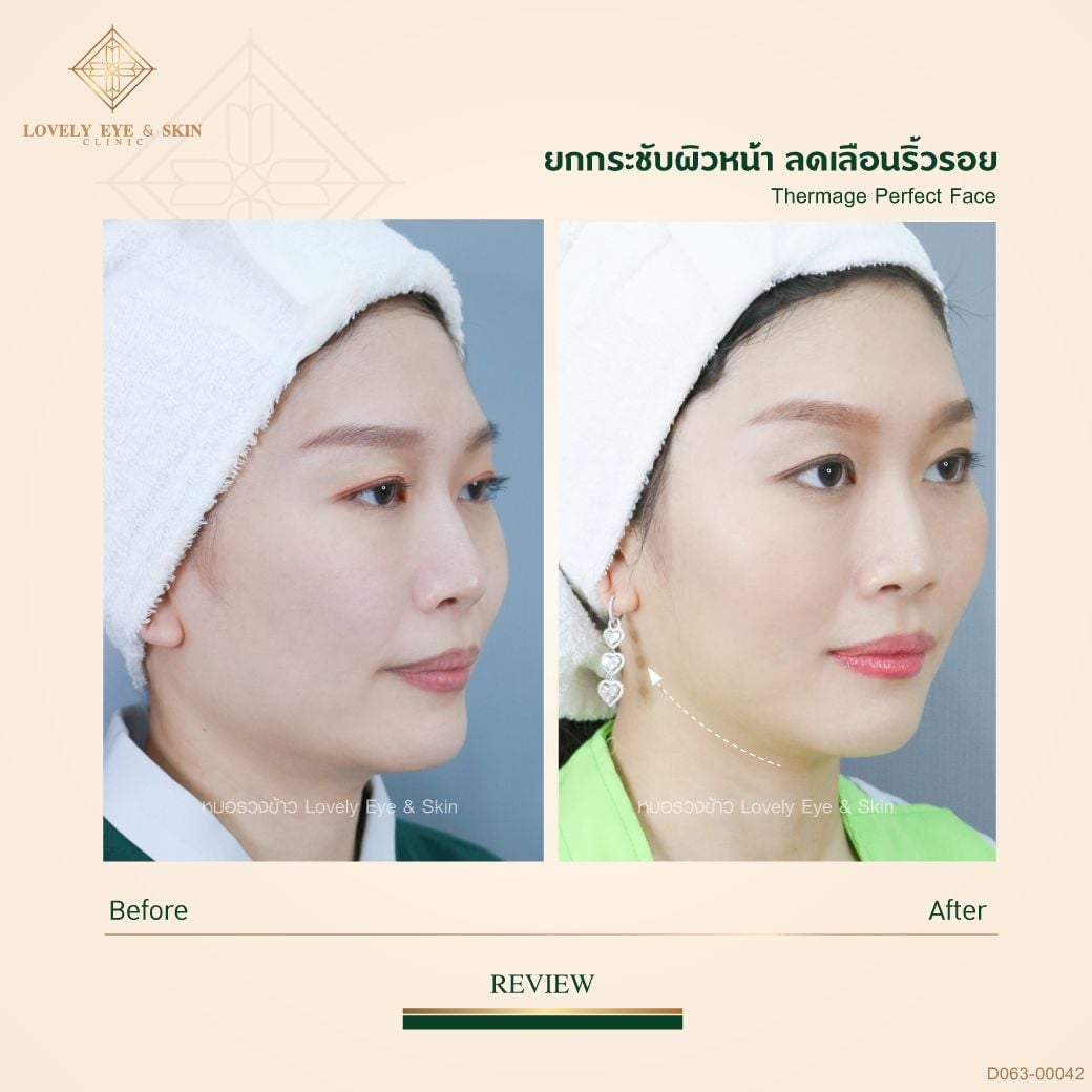 Thermage-CPT-Review.jpg