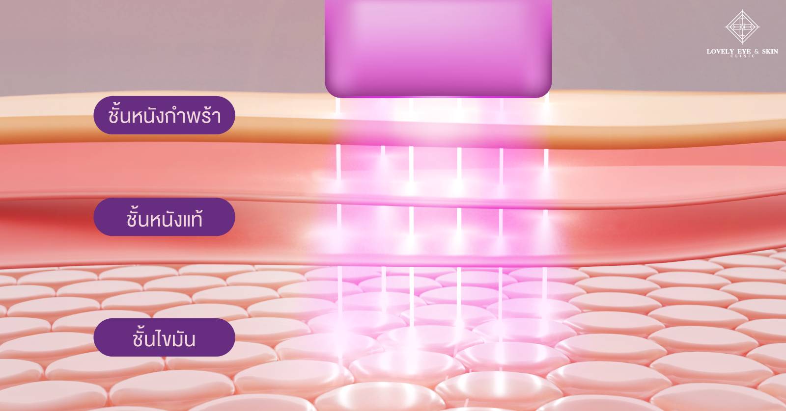 Thermage-FLX-Perfect-Face-Skin-Layer.jpg