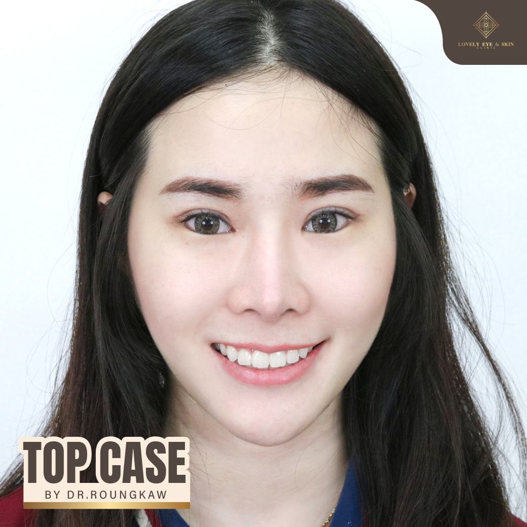 รีวิวตาชั้นเดียว ทำตาสองชั้นกับหมอรวงข้าว
