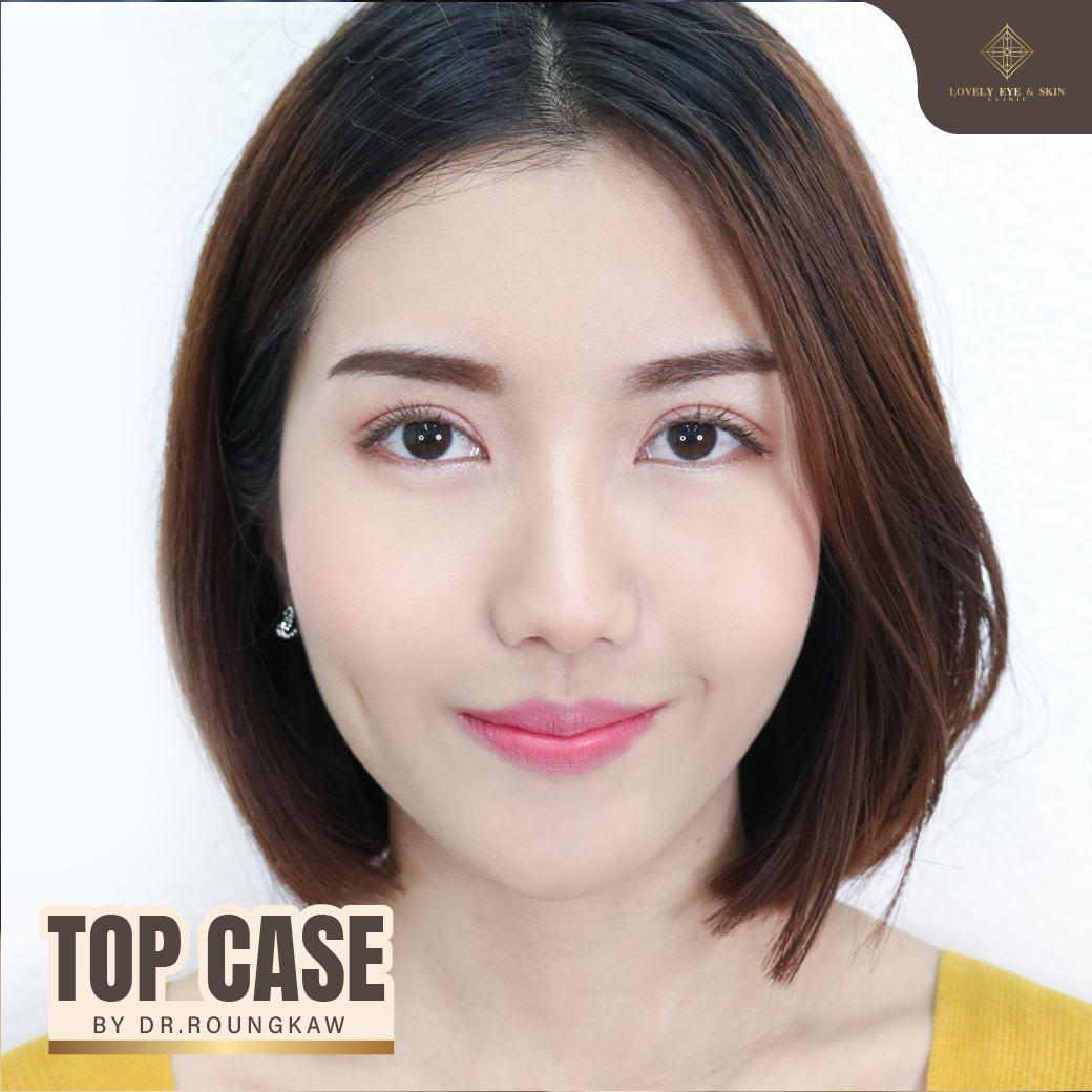 รีวิวตาชั้นหลบใน ทำตาสองชั้นกับหมอรวงข้าว