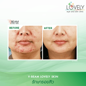 VBEAM Lovely Skin วีบีมลดรอยสิว 3.png
