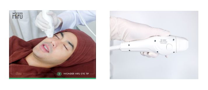 Wonder HIFU ยกกระชับหน้าถึงชั้น SMAS โดยไม่ต้องผ่าตัด.jpg