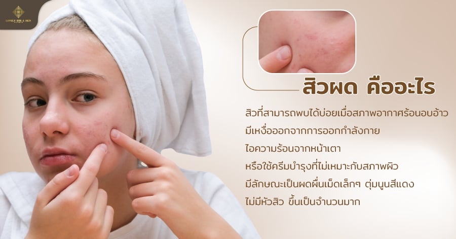สิวผด คือ พบบ่อยเมื่อสภาพอากาศอบอ้าว มีลักษณะเป็นผดผื่นเม็ดเล็กๆ ตุ่มนูนสีแดง ไม่มีหัวสิว