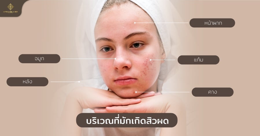 บริเวณที่มักเกิดสิวผด หน้าผาก จมูก แก้ม คาง และที่หลัง