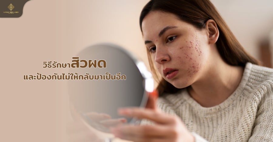 วิธีรักษาสิวผดและป้องกันไม่ให้กลับมาเป็นอีก ล้างหน้าให้สะอาด ใช้ยา หลีกเลี่ยงแสงแดด