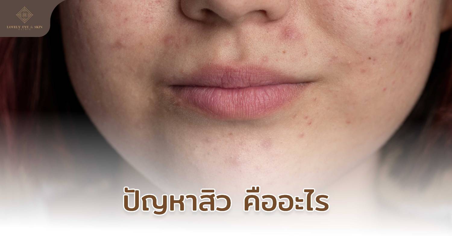 acne-remedies-22.jpg