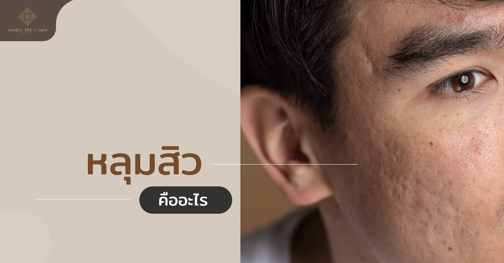 หลุมสิว (Atrophic Scars) คือ ปัญหาผิวชนิดหนึ่งที่เกิดขึ้นหลังจากการเป็นสิวอักเสบ สิวอุดตัน