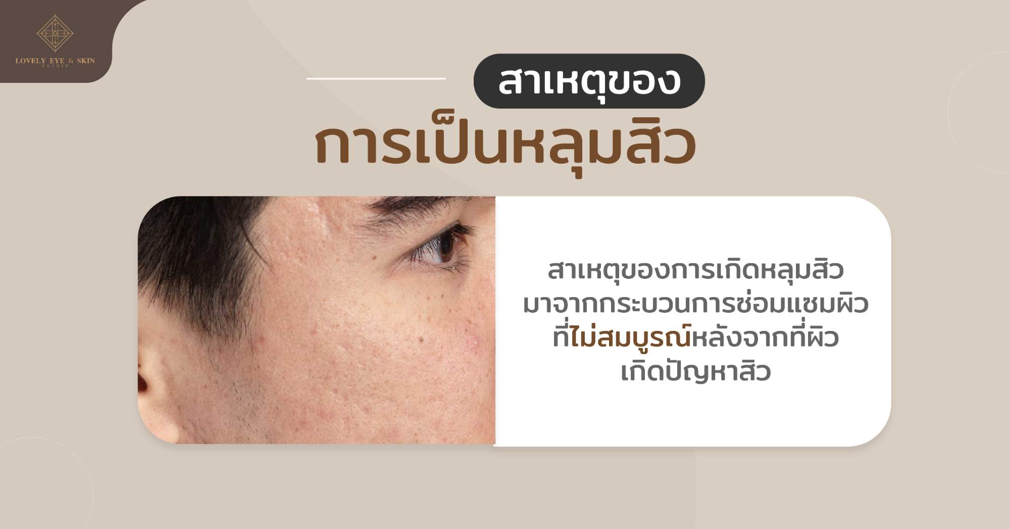 สาเหตุของหลุมสิว เกิดจากการซ่อมแซมผิวที่ไม่สมบูรณ์หลังจากที่ผิวเกิดปัญหาสิว