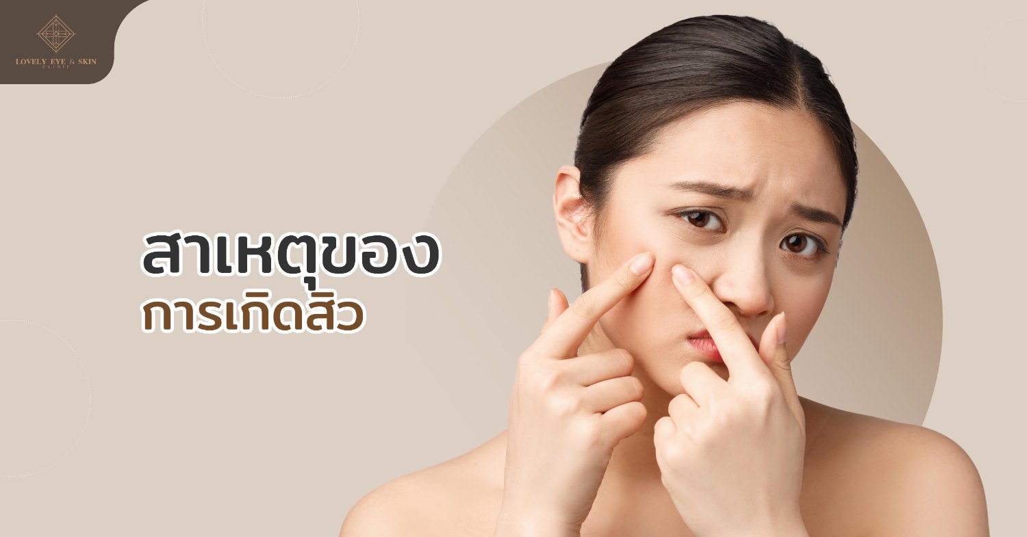 สิว เกิดจากการอุดตันของไขมัน หรือเซลล์ผิวที่ตายแล้ว