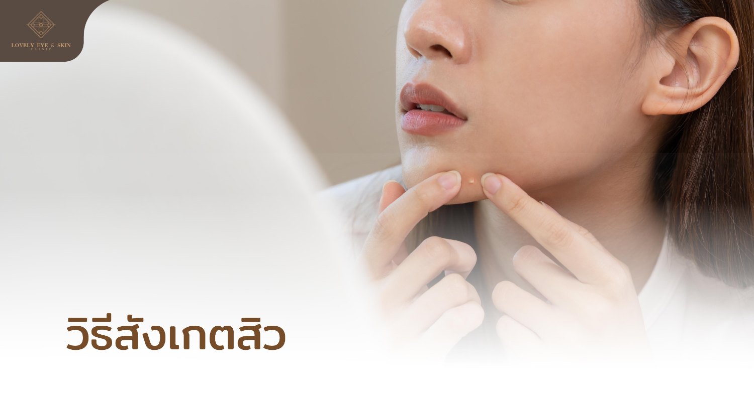 สิวมีหลายประเภท แต่หลักๆ จะมีสิวที่ไม่มีการอักเสบ และสิวที่มีการอักเสบ