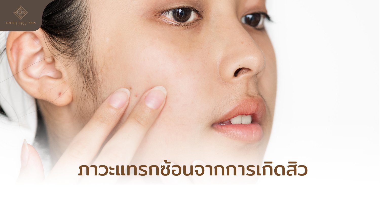 ภาวะที่แทรกซ้อนที่เกิดขึ้นอาจทำให้สิวไม่หาย จนมีปัญหาความกังวล หรือความเครียด