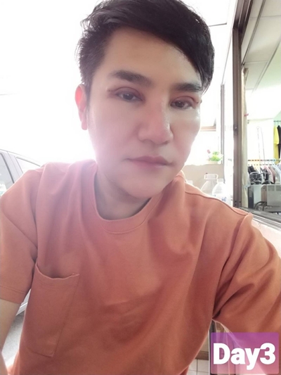 หลังทำตาสองชั้น 3 วัน ไม่เจ็บ บวมน้อยมาก