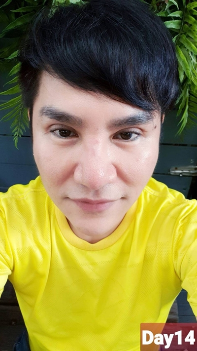 หลังทำตาสองชั้น 14 วัน ชั้นตาเข้าที่