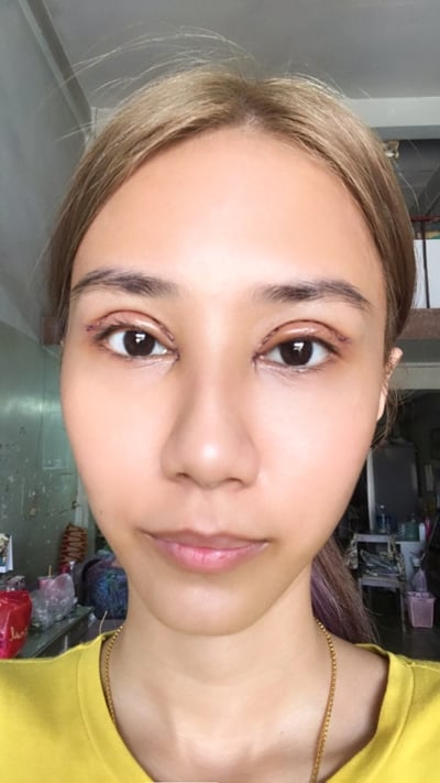 แก้ตาสองชั้น หมอรวงข้าว