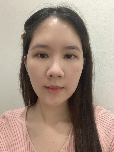 ยกหางตาซ่อนแผลใต้คิ้ว ยกใต้คิ้ว หางตาตก Sub-brow lift
