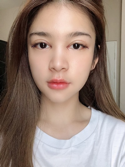 หลังเปิดหัวตา+เปิดหางตา 1 วัน ไม่ค่อยรู้สึกเจ็บ