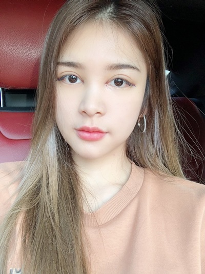หลังเปิดหัวตา+เปิดหางตา 2 วัน รูปทรงดวงตาเรียวยาวขึ้นอย่างที่อยากได้