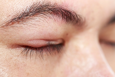 ภาวะขนตาทิ่มตานี้ อาจเกิดได้จากหลายสาเหตุ เช่น ภาวะเปลือกตาอักเสบ
