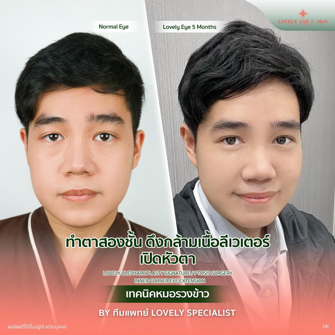 รีวิวศัลยกรรมตาปรับโหวงเฮ้ง คุณผู้ชาย ที่ Lovely Eye & Skin Clinic