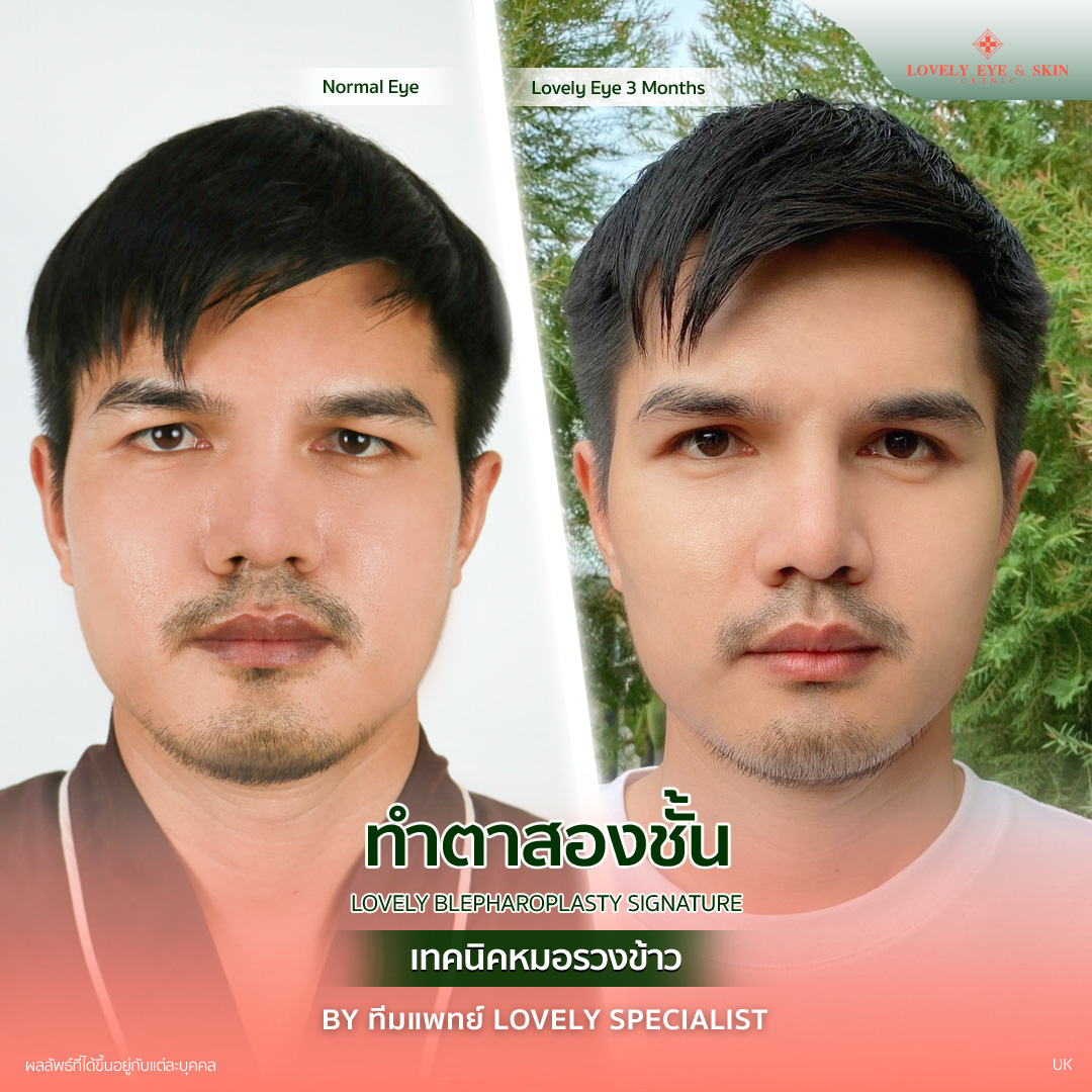 รีวิวศัลยกรรมตาปรับโหวงเฮ้ง คุณผู้ชาย ที่ Lovely Eye & Skin Clinic