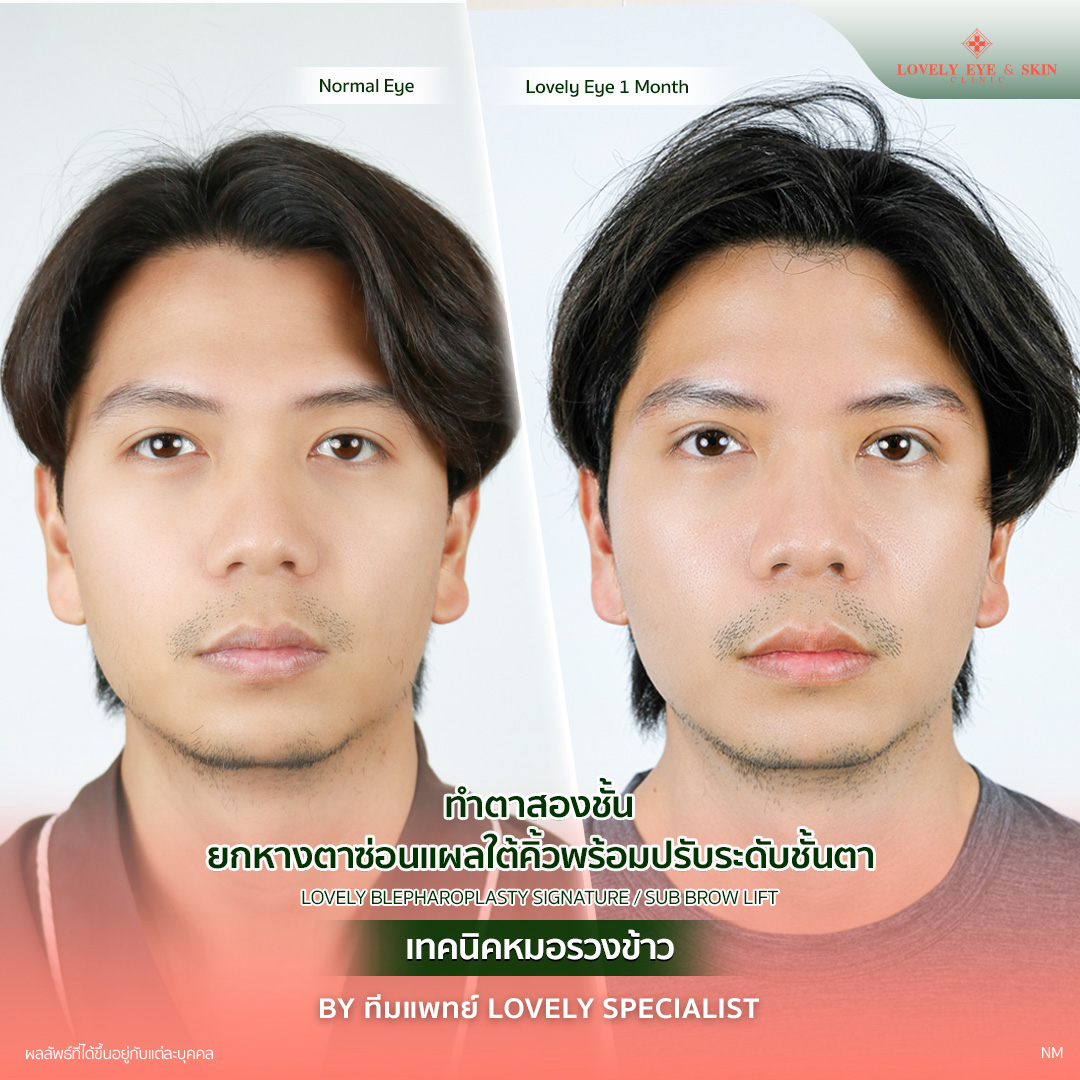 รีวิวศัลยกรรมตาปรับโหวงเฮ้ง คุณผู้ชาย ที่ Lovely Eye & Skin Clinic