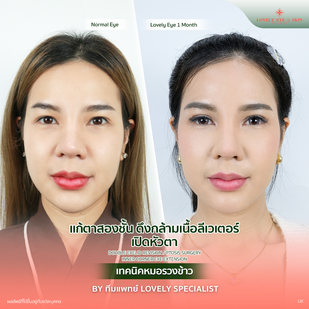 แก้ตาสองชั้น ดึงกล้ามเนื้อลีเวเตอร์ เปิดหัวตา