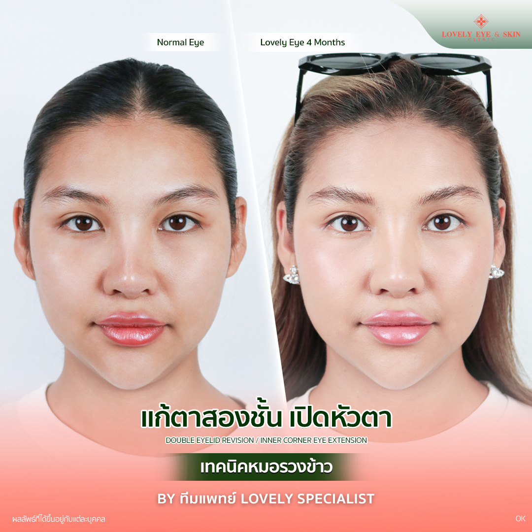 แก้ตาสองชั้น เปิดหัวตา