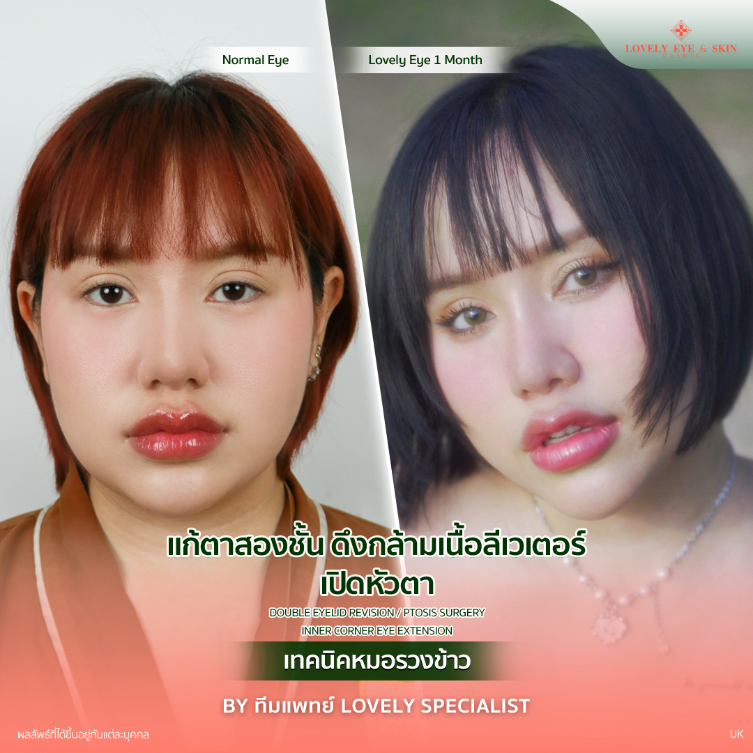 แก้ตาสองชั้น ดึงกล้ามเนื้อลีเวเตอร์ เปิดหัวตา