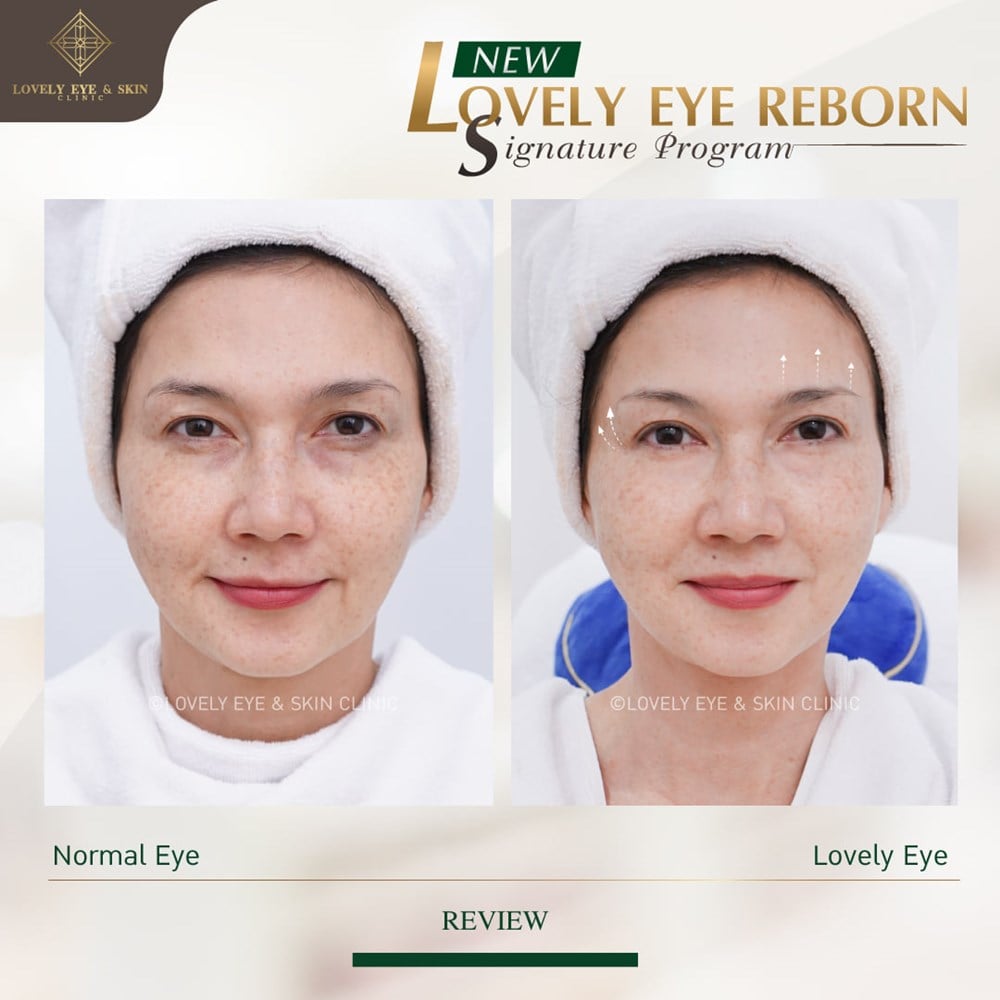 Thermage Eye Reborn ตาสวย ล็อกตาเป๊ะ ยกกระชับ แก้ปัญหาชั้นตาไม่เท่ากันได้