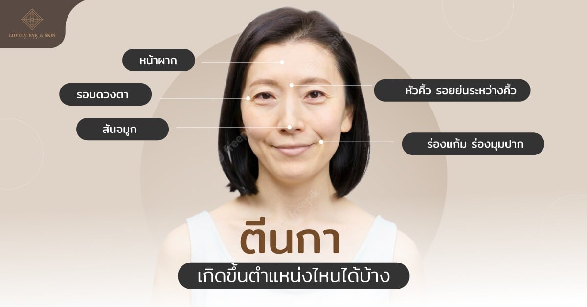 ริ้วรอยตีนกาสามารถขึ้นได้ตามตำแหน่งต่างๆ ของใบหน้า เช่น หน้าผาก หัวคิ้ว