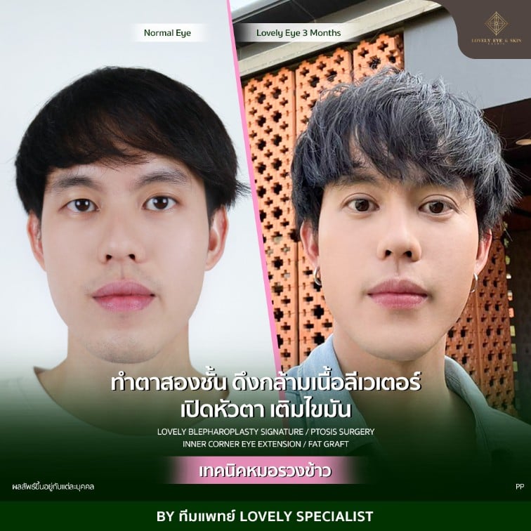 รีวิว ทำตา หมอรวงข้าว ตาไม่เท่ากัน ตาขวาจะดูเล็กและดูตกกว่าตาซ้าย มีปัญหาในส่วนของการลืมตาไม่สุด