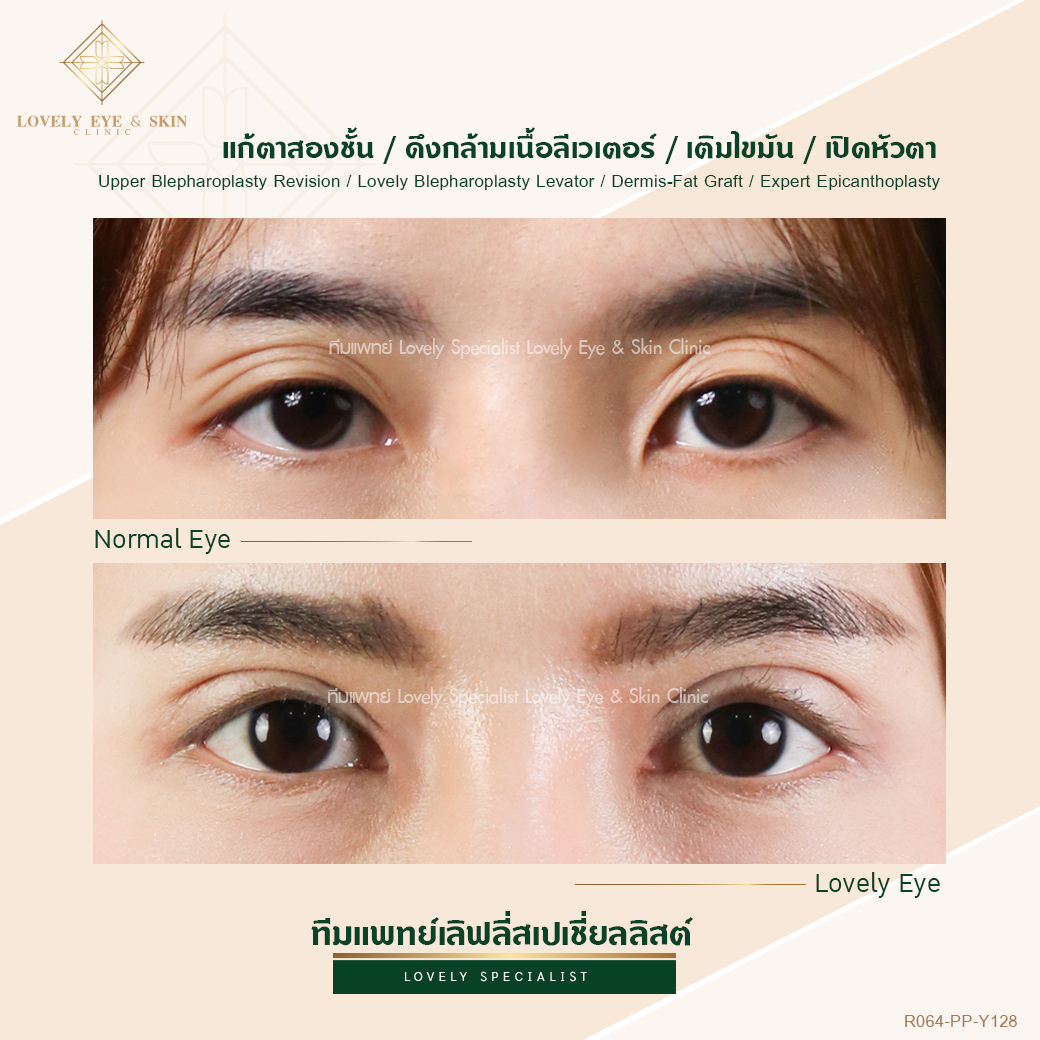 ตาสามชั้น แก้ยังไง