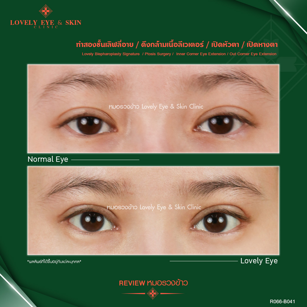 Woman with eye surgery