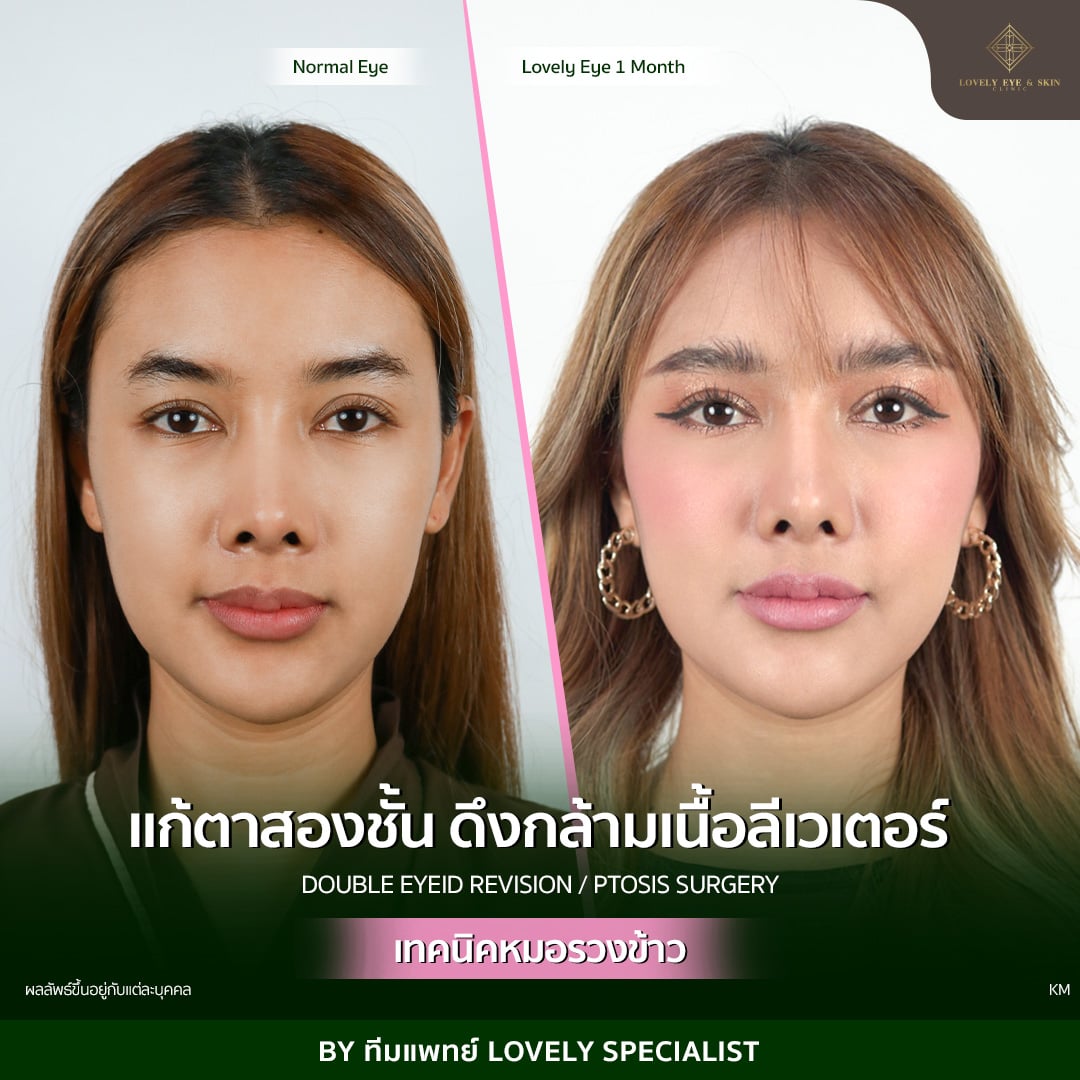 แก้ตาสองชั้น เทคนิคหมอรวงข้าว