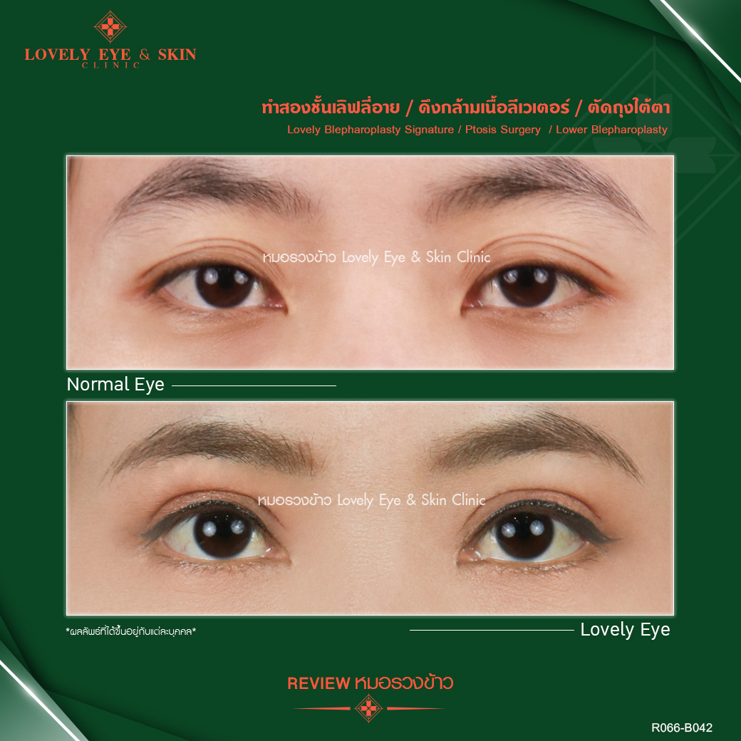 ตาสามชั้นเกิดจากอะไร