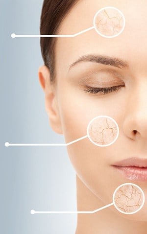 melasma.jpg