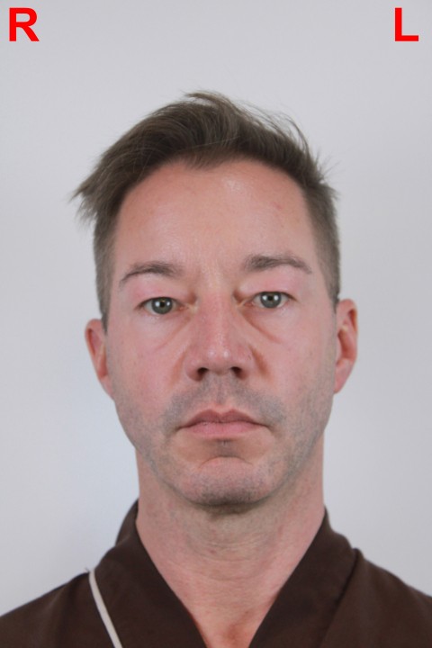 before lower blepharoplasty in Thailand