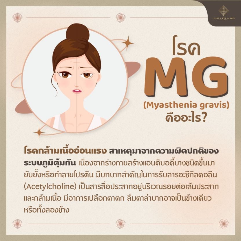โรค MG หรือโรคกล้ามเนื้อตาอ่อนแรง สาเหตุ คืออะไร 