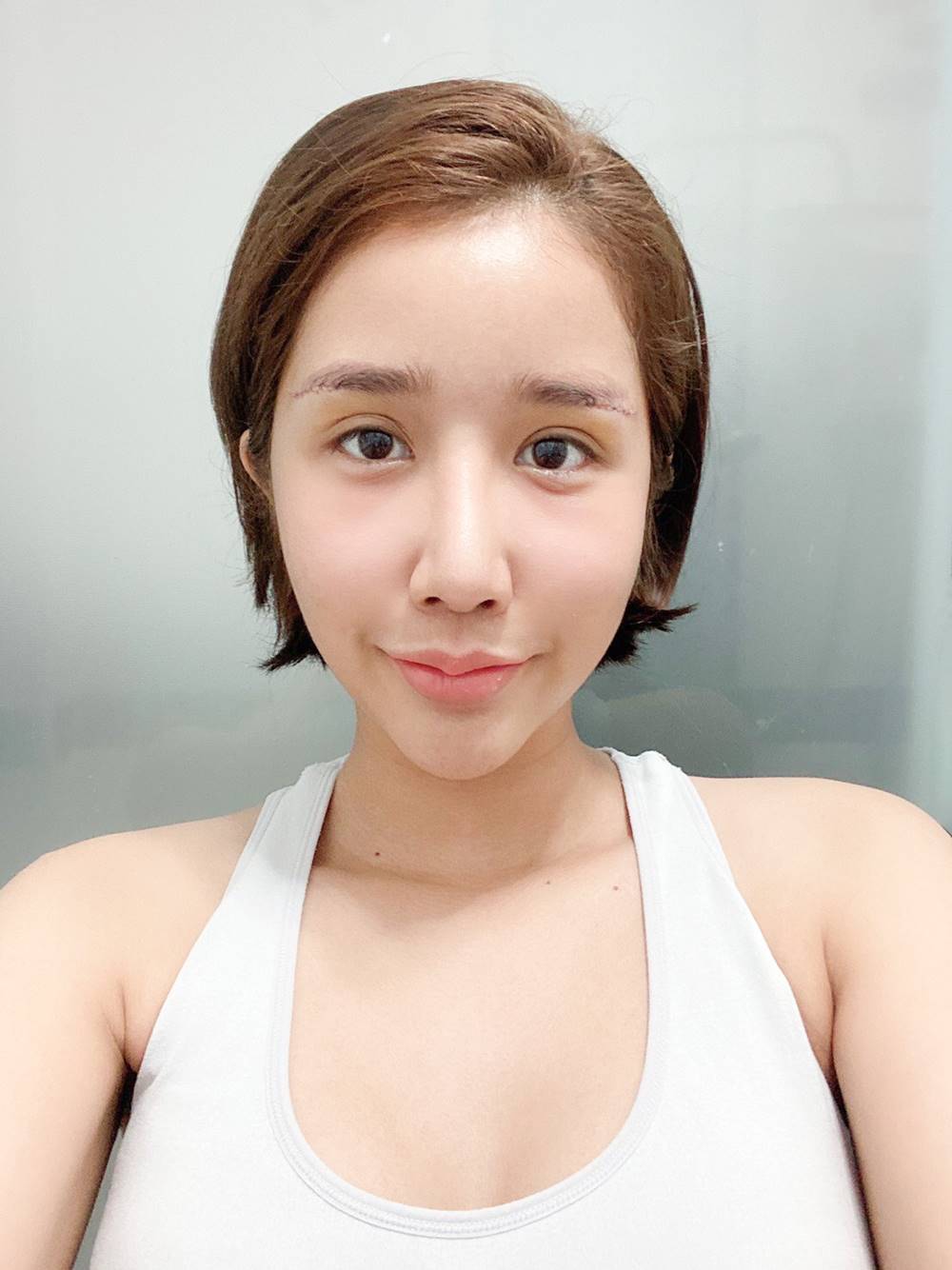 หลังยกหางตาซ่อนแผลใต้คิ้ว 10 วัน