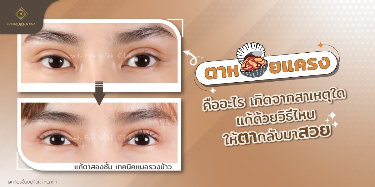 ตาหอยแครงคืออะไร เกิดจากสาเหตุใด แก้ด้วยวิธีไหนให้ตากลับมาสวย