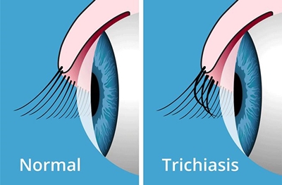 ขนตาทิ่มตา (Trichiasis) เป็นภาวะขนตางอกในทิศทางผิดปกติ