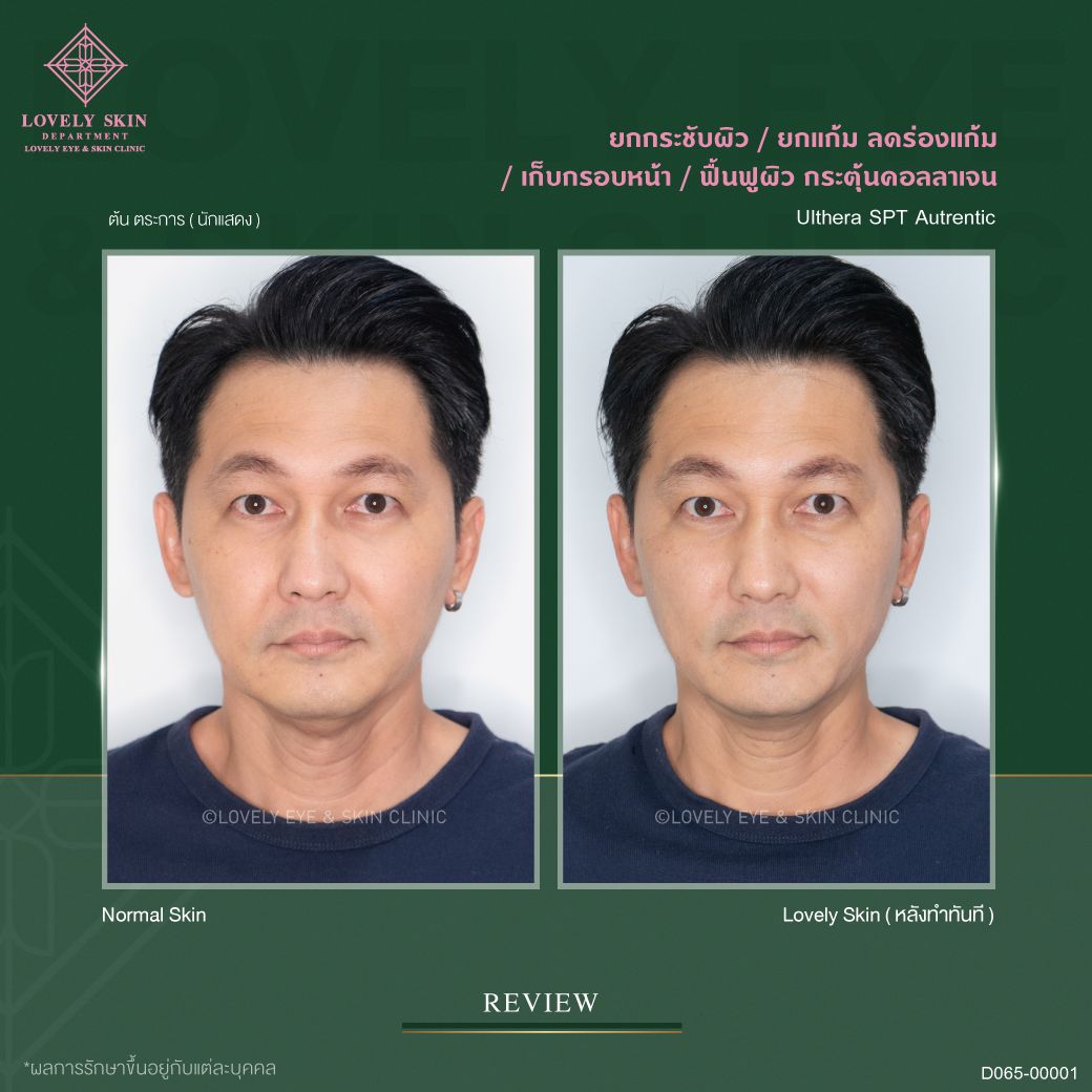 ulthera ผิวหน้ากระชับ กรอบหน้าชัดขึ้น ร่องแก้มตื้นขึ้น ผิวดูสดใส