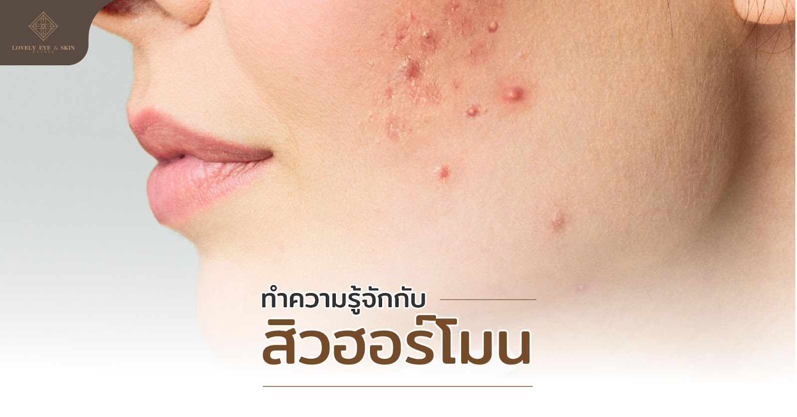 สิวฮอร์โมนเกิดจากการที่มีฮอร์โมนมากระตุ้นการผลิตน้ำมัน