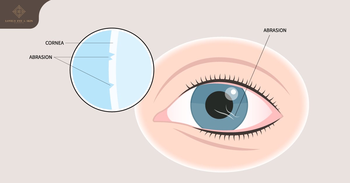 กระจกตาถลอก (Corneal Abrasion)