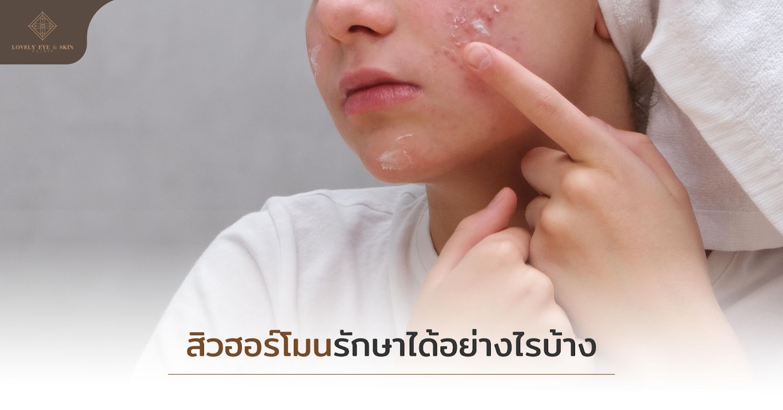 สิวฮอร์โมนรักษาได้อย่างไรบ้าง