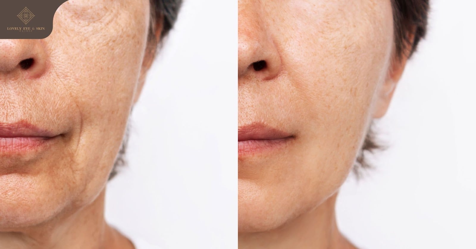การทำ Thermage เหมาะกับคนที่มีปัญหาผิวมีรอยรอยย่น ใต้คางมีเหนียงเยอะ
