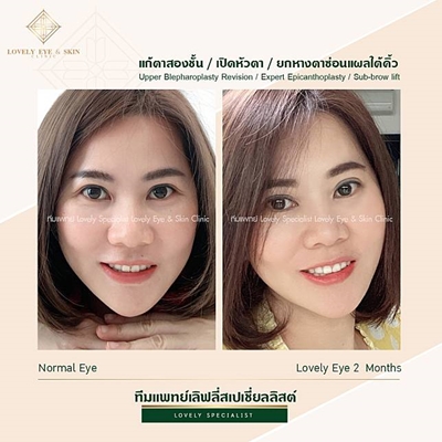ทำตาสองชั้น หมอรวงข้าว