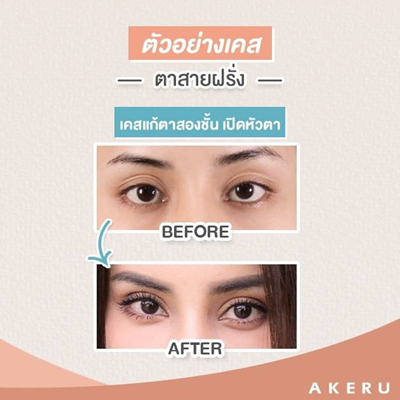 ทำตาสองชั้น เปิดหัวตา ตาสายเกาหลี ตาสายฝอ ตาสายฝรั่ง