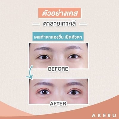ทำตาสองชั้น เปิดหัวตา ตาสายเกาหลี ตาสายฝอ ตาสายฝรั่ง