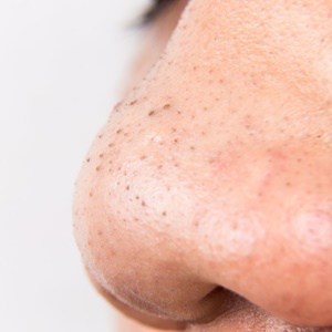 what-is-a-blackhead.jpg